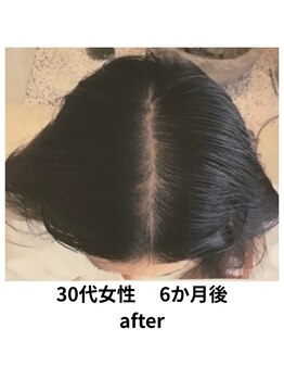 イーズ/リバイタ 梅田本店/【ケース2】３０代女性　after