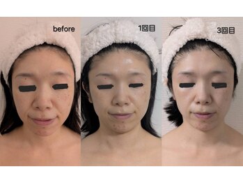 レゾン 京橋店/【Before/after】最新韓国美容★