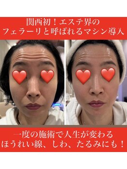 エムプリュ 心斎橋店(M.plus)/サーモシェイプフェイシャル