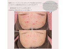 ビースタジオブランジュ(B STUDIO blange)/HAAB REPRO◇ハーブピーリング