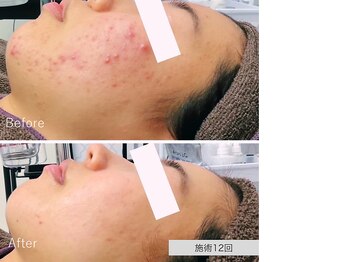 ニキビ研究所 千葉店/どんなニキビでもお任せください