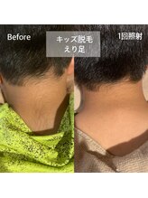 アンダンテ(Andante)/キッズ襟足（うなじ）脱毛