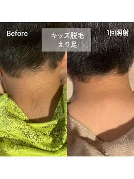 アンダンテ(Andante)/キッズ襟足（うなじ）脱毛