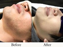 【メンズ人気No,1★ヒゲ脱毛】脱毛することで美肌効果も◎