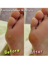 ニコルル 春日部店(Nicolulu)/魚の目ビフォーアフター