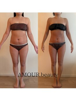 アムール ビューティ(Amour.beauty)の写真/結果重視◎ハイパーナイフ×デトックス痩身リンパで相乗効果に期待大♪代謝UP&むくみ解消にも最適！