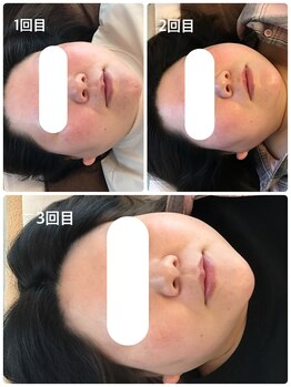 アジサイ(Ajisai)/光フォトで赤顔のお悩み改善