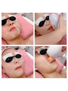 スパフランコルシャン(Spa Francorchamps)/お顔脱毛(鼻下）こだわり施術