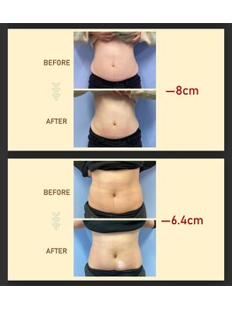 フェリーチェ ビューティー(Felice Beauty)/最新式ソニックマイクロニードル