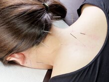 しろねこ鍼灸マッサージ院/首肩鍼灸