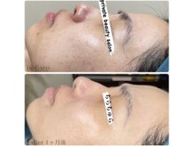 ちらちゅら/クリスティーナ【施術経過】