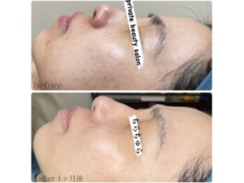 ちらちゅら/クリスティーナ【施術経過】