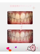 ハチ(HACHI)/＃医療提携ホワイトニング