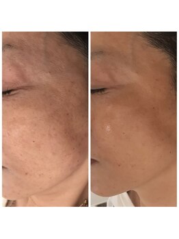 ノフ 恵比寿(noff)/bf/af【ダクトピール】