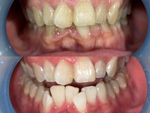 ダンブランシュサンダ(dents Blanches SANDA)/【ビフォーアフター】3回