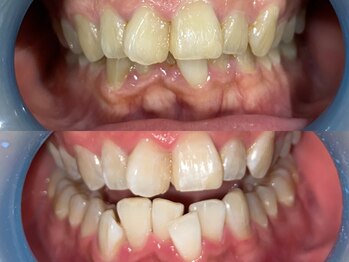 ダンブランシュサンダ(dents Blanches SANDA)/【ビフォーアフター】3回