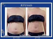 ビテュセ(美Tu sais)/【痩身・ダイエット】ボディケア