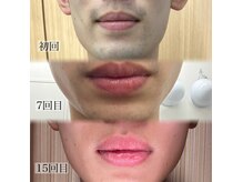 ヒゲのbefore＆after☆垢抜け効果◎