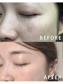 レモンスタジオ(Lemon studio)/韓国肌管理|シミケア