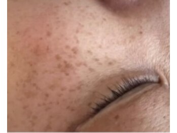 ミライ(Mirai)の写真/医療提携サロン*今出ているシミも潜んでいるシミも同時にアプローチ◎薄いシミも濃いシミケアもお任せ♪