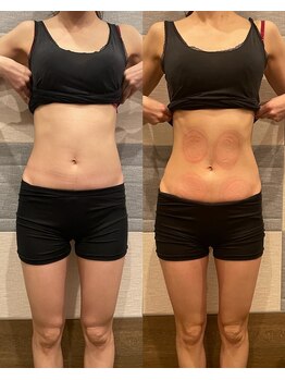 長寿鍼灸院 長寿整骨院/EMS＜お腹集中コース＞