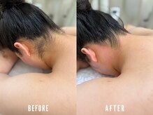 ビーグラム(B.GLAM)/ダブル脱毛／うなじ＋背中