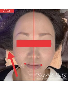 ユフラ(Juhla)/切らない小顔リフト