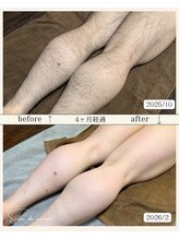 サロンド モーモ(SALON de mo-mo)/４ヶ月でこの結果：脚