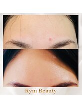 リム ビューティー(RYM BEAUTY)/ニキビケア、肌荒れにも