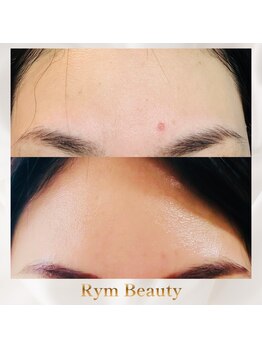 リム ビューティー(RYM BEAUTY)/ニキビケア、肌荒れにも