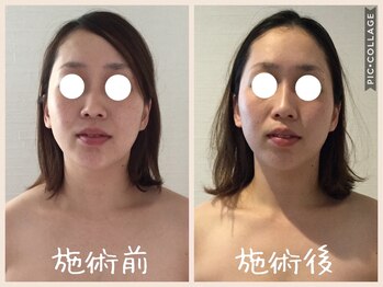 癒しの隠れ家サロン シュシュ(CHOU*CHOU)/フェイスリンパ90分施術前施術後