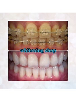 ホワイトニングショップ 奈良香芝店(Whitening shop)/矯正中もセルフホワイトニングOK