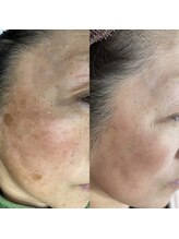 サロン ド ルミナ(salon de lumina)/ADS肌改善