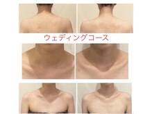 ミエル(Miel)/Before After