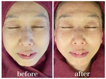 ルー ハナレ 神戸岡本 摂津本山店(Luu HANARE)/小顔リフトアップ　しわ改善