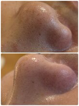 ミエル(miel)/【ハーブピーリング】毛穴洗浄