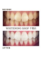 ホワイトニングショップ 千葉店/どんな歯でもOKなホワイトニング