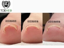 オズ ネイルアンドアイ(OZ NAIL&EYE)/巻き爪▽爪に負担なく痛みを軽減