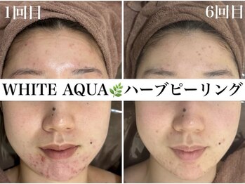 ホワイトアクア 京橋店(WHITE AQUA)/ニキビ6回ビフォーアフター