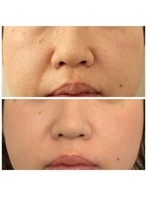 イーオ(io)/40代、小顔&鼻が小さく&高く！