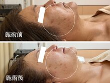 キーオブフェイス(Key of Face)/お悩み【顔全体小さくしたい】