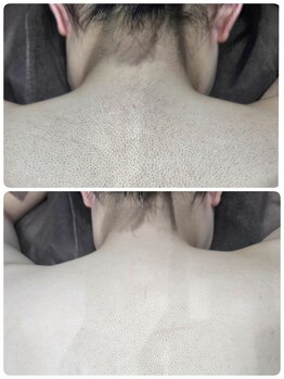 ランシス(RanSis)/背中脱毛