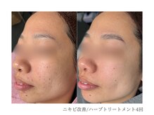 ルーム(room)/ハーブトリートメント4回