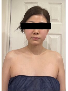 リバース(Rebirth)/脂肪燃焼剤導入・ビフォー