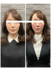 長寿鍼灸院 長寿整骨院/ハリネズミ女優美容鍼効果★