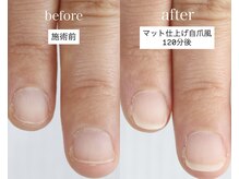 男性、医師、保育関係さまに支持の多い深爪矯正自爪風仕上げ