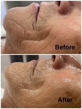 クラッシー 本八幡(CLASSY+)/深いシワにも効果あり！