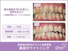クレア(Crea)/【ホワイトニング症例写真】