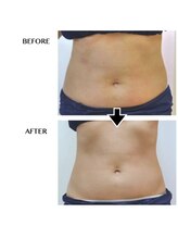 キレピア 熊本インター店(kirepia)/キャビテーション3ヶ月目♪