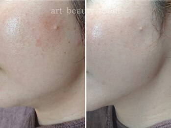 アート ビューティールーム(art beauty room)/☆OPL 光フェイシャル＆オーダー